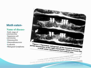 Moth eaten-
Name of disease-
•Early stage of
osteosarcoma
•Squamous cell
carcionoma
•Osteomyelitis
•Osteoradionecrosis
•Leukemia
•Malognant lymphoma
 