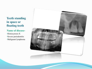 Teeth standing
in space or
floating teeth
Name of disease-
•Histiocytosis-X
•Severe periodontitis
•Malignant lymphoma
 