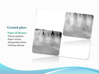 Ground glass-
Name of disease-
•Fibrous dysplasia
•Paget’s disease
•Hypeparathyroidism
•Ossifying fibroma
 