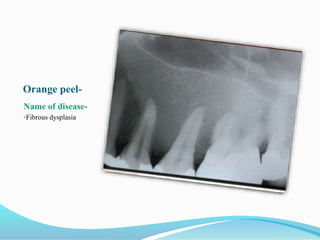 Orange peel-
Name of disease-
•Fibrous dysplasia
 