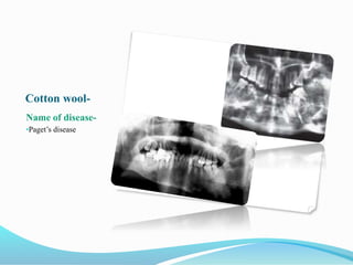 Cotton wool-
Name of disease-
•Paget’s disease
 