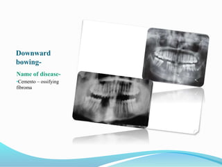Downward
bowing-
Name of disease-
•Cemento – ossifying
fibroma
 
