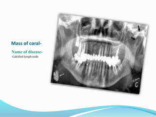 Mass of coral-
Name of disease-
•Calcified lymph node
 