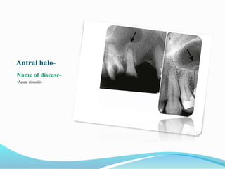 Antral halo-
Name of disease-
•Acute sinusitis
 