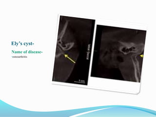 Ely’s cyst-
Name of disease-
•osteoarthritis
 