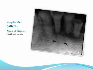 Step ladder
pattern-
Name of disease-
•Sickle cell anemia
 