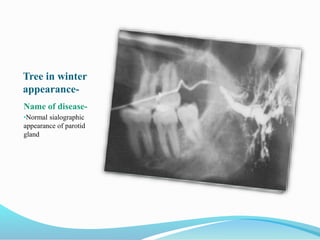 Tree in winter
appearance-
Name of disease-
•Normal sialographic
appearance of parotid
gland
 