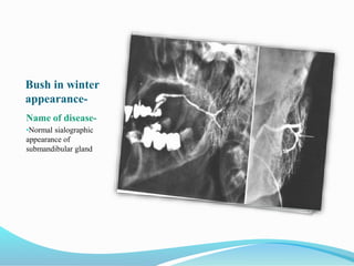 Bush in winter
appearance-
Name of disease-
•Normal sialographic
appearance of
submandibular gland
 