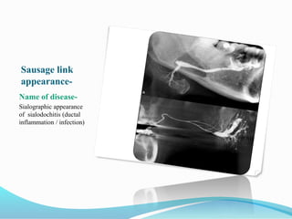 Sausage link
appearance-
Name of disease-
Sialographic appearance
of sialodochitis (ductal
inflammation / infection)
 
