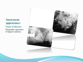 Snowstorm
appearance-
Name of disease-
Sialographic appearance
of Sjӧgren’syndrome.
 