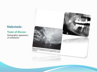 Sialectasis-
Name of disease-
Sialographic appearance
of sialadenitis.
 