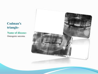 Codman’s
triangle-
Name of disease-
Osteogenic sarcoma.
 
