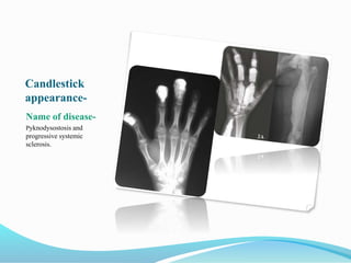 Candlestick
appearance-
Name of disease-
Pyknodysostosis and
progressive systemic
sclerosis.
 