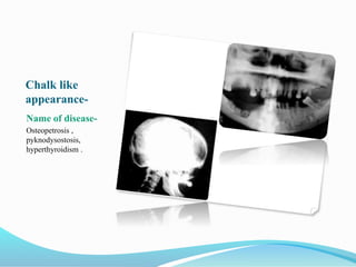Chalk like
appearance-
Name of disease-
Osteopetrosis ,
pyknodysostosis,
hyperthyroidism .
 