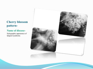 Cherry blossom
pattern-
Name of disease-
Sialographic appearance of
Sjӧgren’syndrome.
 