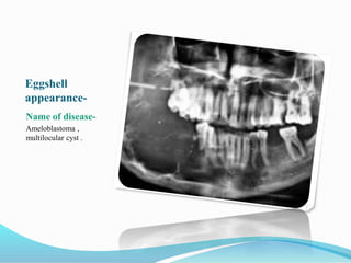 Eggshell
appearance-
Name of disease-
Ameloblastoma ,
multilocular cyst .
 