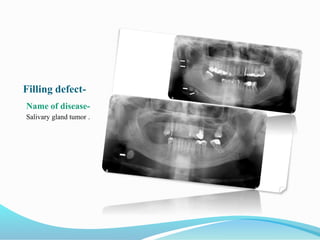 Filling defect-
Name of disease-
Salivary gland tumor .
 