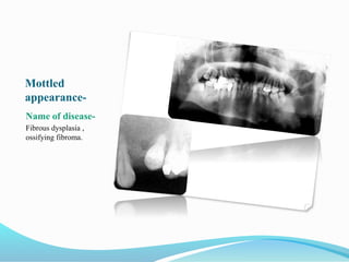 Mottled
appearance-
Name of disease-
Fibrous dysplasia ,
ossifying fibroma.
 