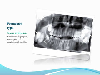 Permeated
type-
Name of disease-
Carcinoma of gingiva ,
squampous cell
carcinoma of maxilla.
 