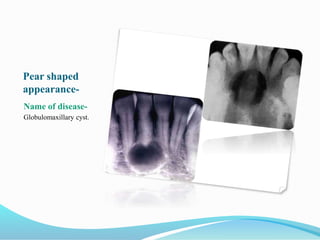 Pear shaped
appearance-
Name of disease-
Globulomaxillary cyst.
 