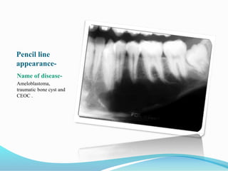 Pencil line
appearance-
Name of disease-
Ameloblastoma,
traumatic bone cyst and
CEOC .
 