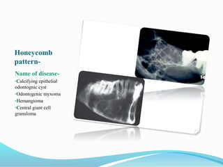 Honeycomb
pattern-
Name of disease-
•Calcifying epithelial
odontognic cyst
•Odontogenic myxoma
•Hemangioma
•Central giant cell
granuloma
 