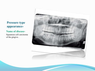 Pressure type
appearance-
Name of disease-
Squamous cell carcinoma
of the gingiva .
 