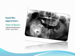 Sand like
appearance-
Name of disease-
Adenoameloblastoma ,
CEOC and CEOT .
 