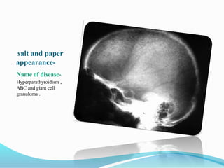 salt and paper
appearance-
Name of disease-
Hyperparathyroidism ,
ABC and giant cell
granuloma .
 