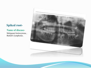Spiked root-
Name of disease-
Malignant histiocytoma ,
Burkitt's lymphoma .
 