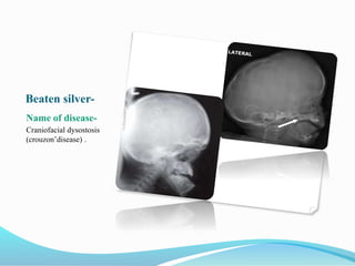 Beaten silver-
Name of disease-
Craniofacial dysostosis
(crouzon’disease) .
 