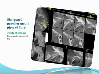 Sharpened
pencil or mouth
piece of flute-
Name of disease-
Rheumatoid arthritis of
tmj .
 