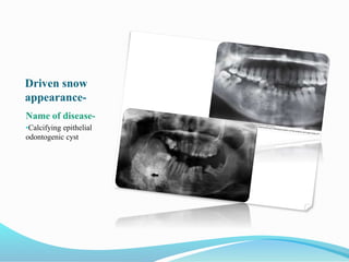Driven snow
appearance-
Name of disease-
•Calcifying epithelial
odontogenic cyst
 