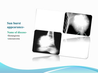 Sun burst
appearance-
Name of disease-
•Hemangioma
•osteosarcoma
 