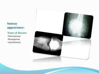 Sunray
appearance-
Name of disease-
•Osteosarcoma
•Hemangioma
•osteoblastoma
 
