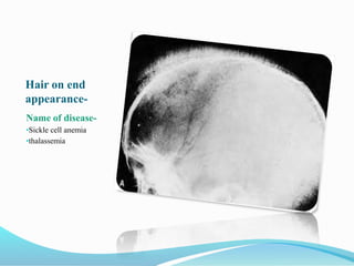Hair on end
appearance-
Name of disease-
•Sickle cell anemia
•thalassemia
 