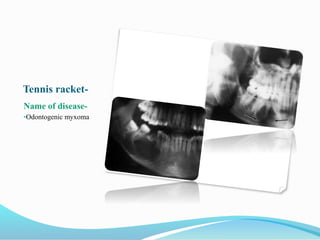 Tennis racket-
Name of disease-
•Odontogenic myxoma
 