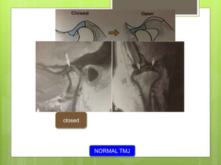 closed
NORMAL TMJ
 
