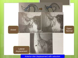 Anterior disk displacement with reduction
closed
Lateral
displacement
Open-
Normal
 