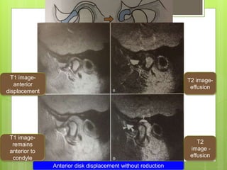 T2
image -
effusion
Anterior disk displacement without reduction
T2 image-
effusion
T1 image-
anterior
displacement
T1 image-
remains
anterior to
condyle
 