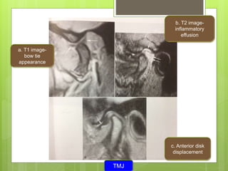 a. T1 image-
bow tie
appearance
b. T2 image-
inflammatory
effusion
c. Anterior disk
displacement
TMJ
 