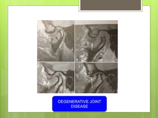 DEGENERATIVE JOINT
DISEASE
 