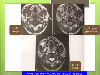 a. T1
image
b. T1 post
gadolinium
c. T2
image
RHABDOMYOSARCOMA- soft tissue of right face
 
