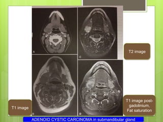 T1 image post-
gadolinium,
Fat saturation
T2 image
T1 image
ADENOID CYSTIC CARCINOMA in submandibular gland
 