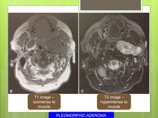 T2 image –
hyperintense to
muscle
T1 image –
isointense to
muscle
PLEOMORPHIC ADENOMA
 