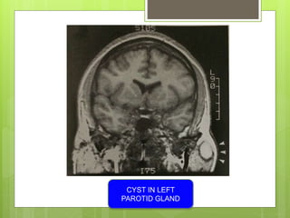 CYST IN LEFT
PAROTID GLAND
 