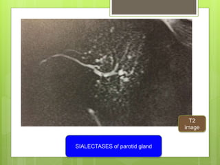 SIALECTASES of parotid gland
T2
image
 