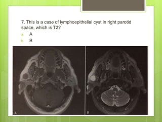 7. This is a case of lymphoepithelial cyst in right parotid
space, which is T2?
a. A
b. B
 