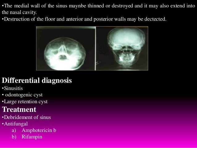 Differential Diagnosis Of Maxillary Sinus Pathology