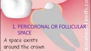 1. PERICORONAL OR FOLLICULAR
SPACE
 
